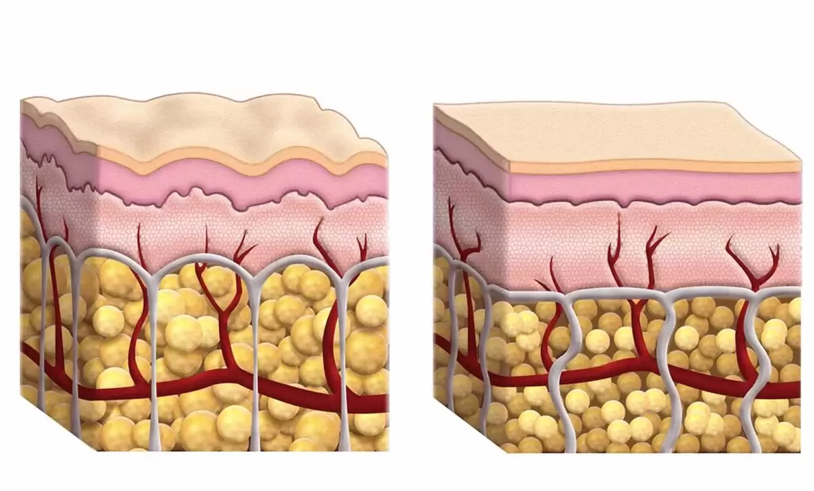 Fat cells while using a keto teacher