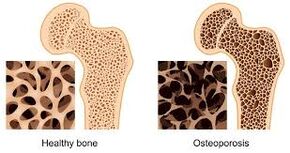 Bone osteoporosis